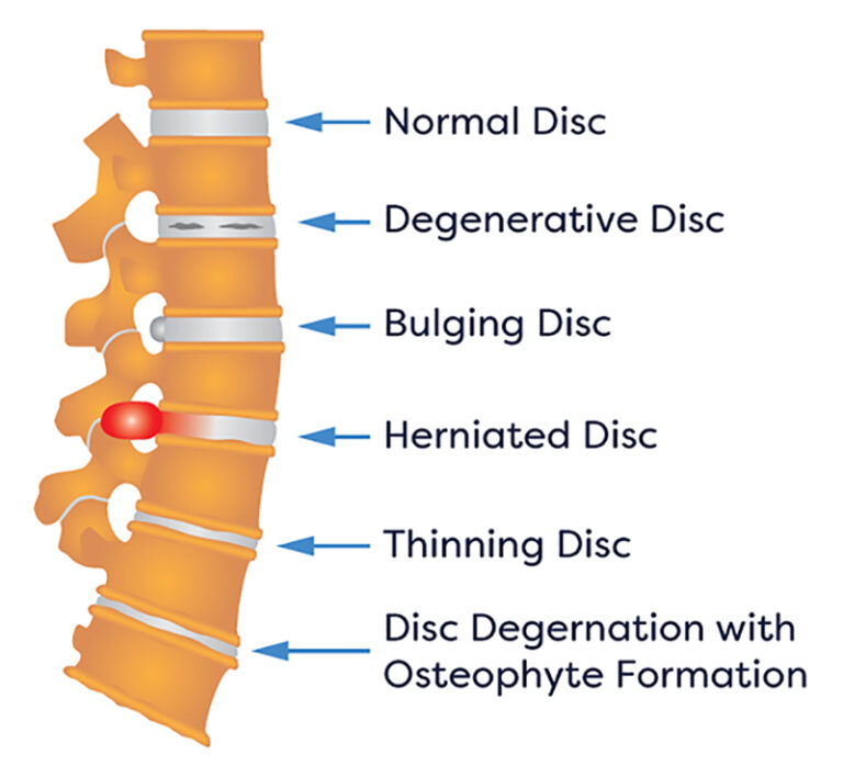 Herniated Disc Treatment Specialists in NJ and NYC Herniated Disc
