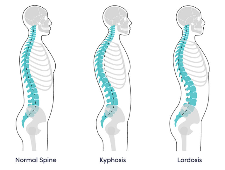 Kyphosis Treatment in NJ and NYC Kyphosis Surgery in New Jersey