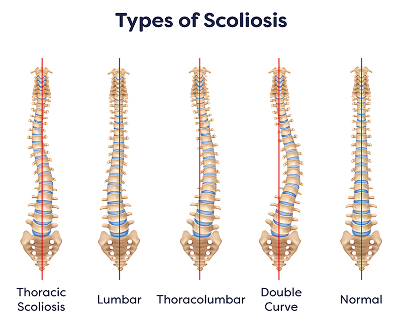 Scoliosis Specialists In NJ Scoliosis Treatment NJ