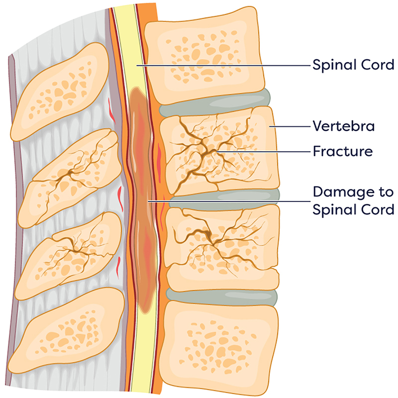 Spinal Cord Injuries