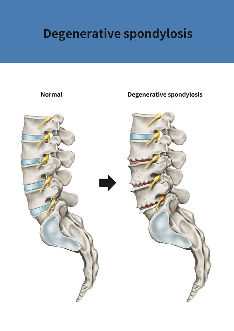 Lumbar Spondylosis Treatment NJ & NYC Premier Brain & Spine